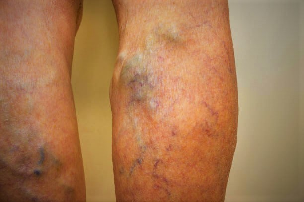 Best Doctor For Varicose Veins In Lokhandwala Andheri